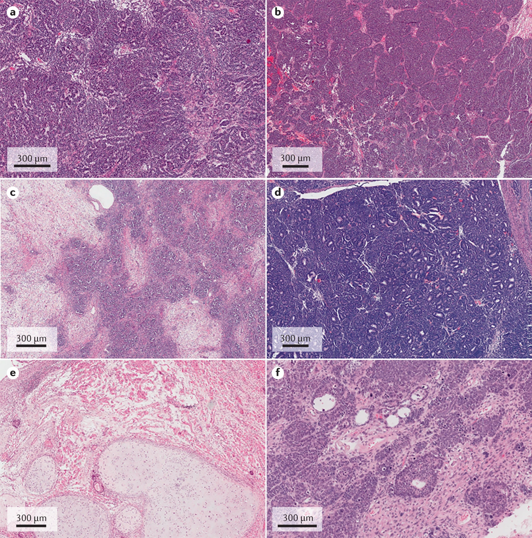 Different histological patterns of Wilms tumour