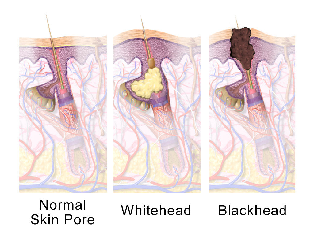Hair follicle anatomy demonstrating a healthy hair follicle (pictured left), a whitehead or closed comedone (middle picture), and a blackhead or open comedone (pictured right)