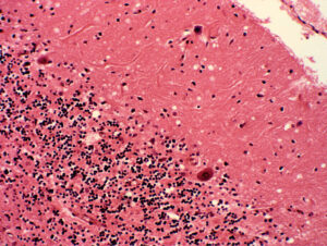 The brain tissue of a person with kuru looks spongy because of holes left by dead cells.