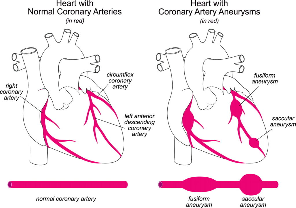 Coronary artery aneurysms