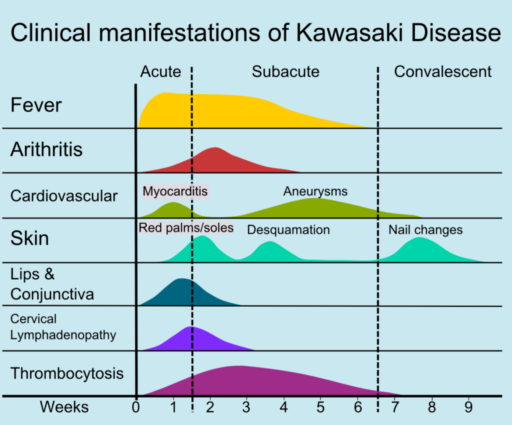Kawasaki disease natural history