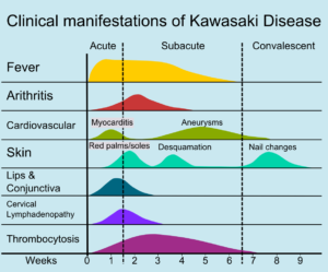 Kawasaki disease natural history