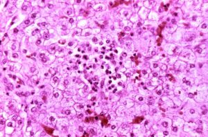 Histopathology of autopsy liver in Reye's syndrome