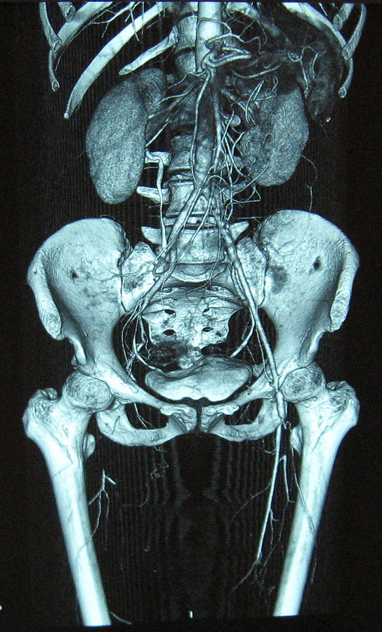 Complete occlusion of the right and stenosis of the left femoral artery as seen in a case of thromboangiitis obliterans