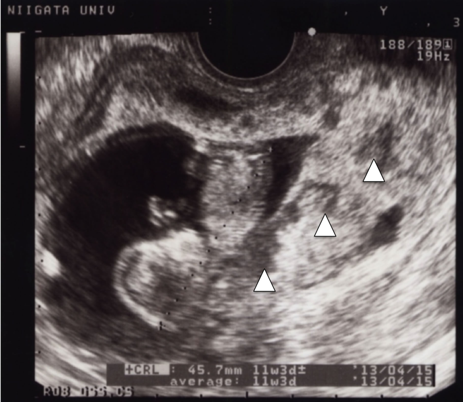Ultrasonogram placental previa
