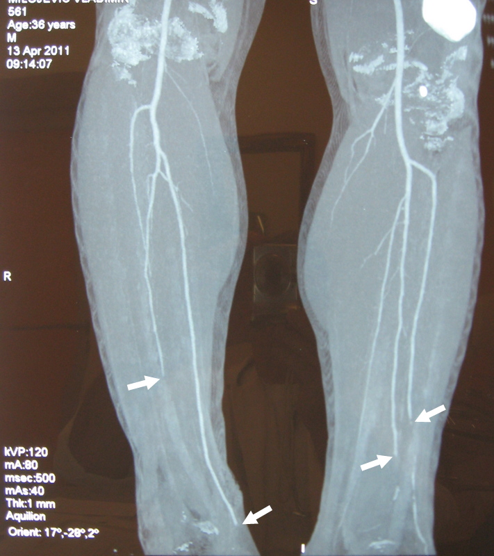 CT angiogram showing segmental stenosis of arteries of the lower leg 