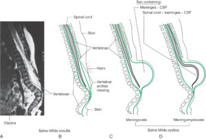 Sagittal views of spina bifida malformations