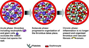 Pathophysiological phases of thromboangiitis obliterans