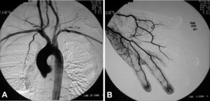 Invasive contrast angiography in a 28-year-old female smoker with thromboangiitis obliterans,