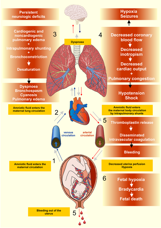 Pathophysiology of the amniotic fluid embolism 