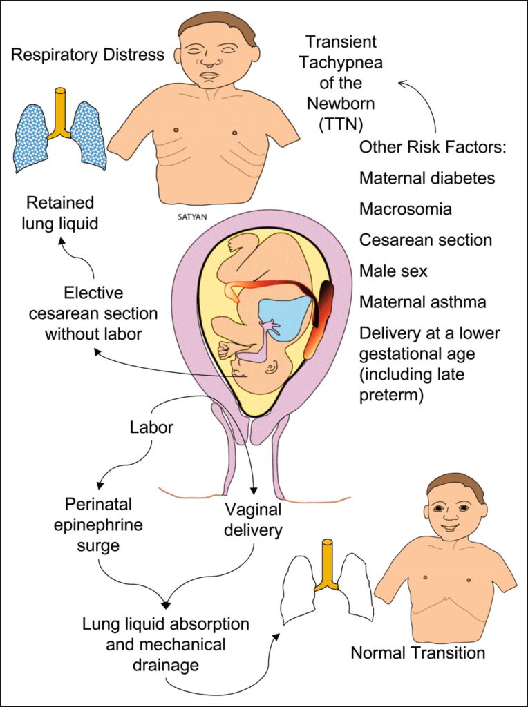 Risk factors associated with transient tachypnea of newborn 