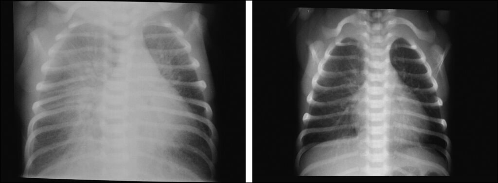 Radiographs of two babies who have transient tachypnea of the newborn of differing severity