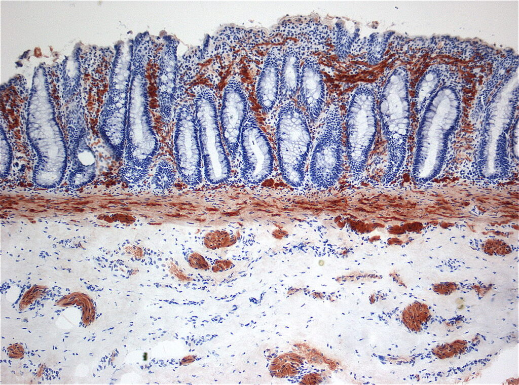 Histopathology of Hirschsprung disease, also known as aganglionosis