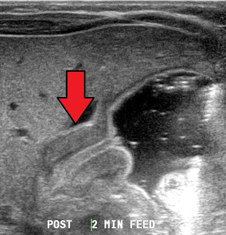 Pyloric stenosis as seen on ultrasound in a 6 week old