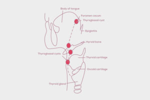 Thyroglossal Duct Cyst locations