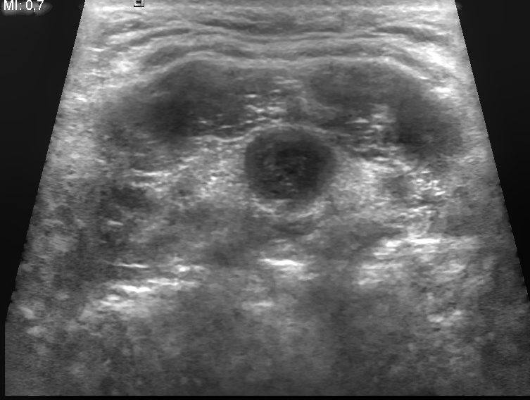 Ultrasound image of thyroglossal duct cyst 