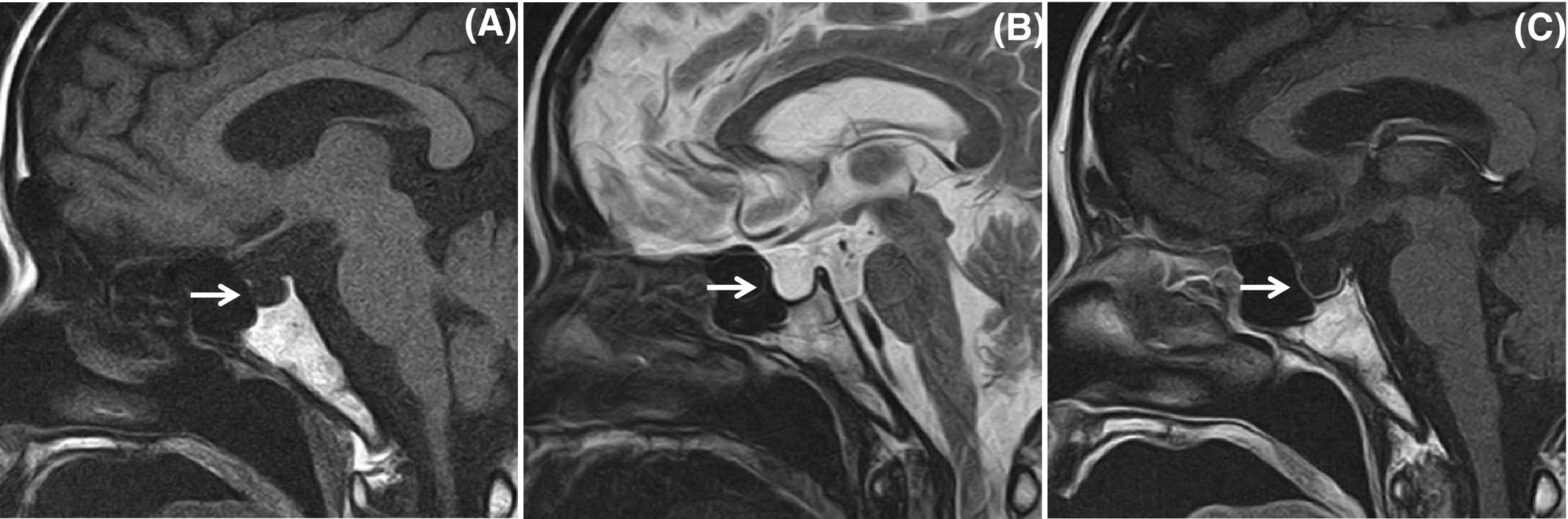 MRI of the pituitary gland (sagittal section); arrows indicate the sella turcica