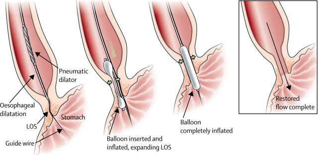Schematic representation of the pneumodilatation procedure