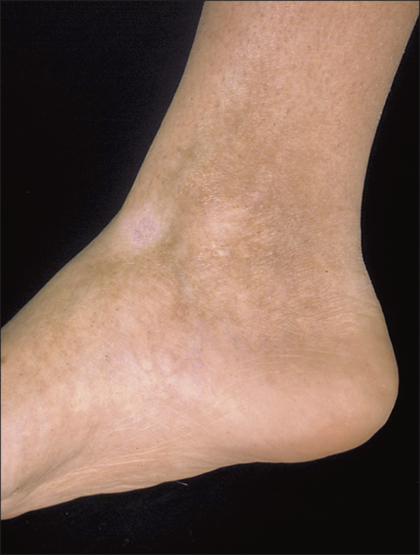 Right ankle demonstrating atrophy and hypopigmentation secondary to corticosteroid injection
