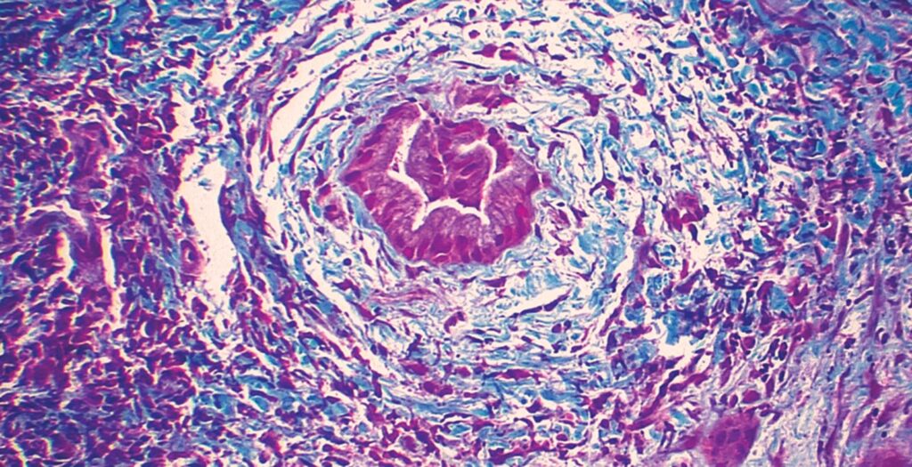 Typical focal lesion of primary sclerosing cholangitis