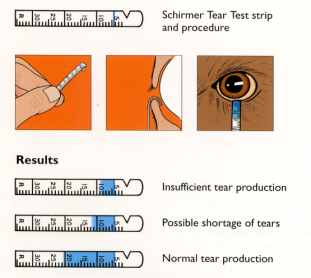 Schirmer test to measure tear secretion