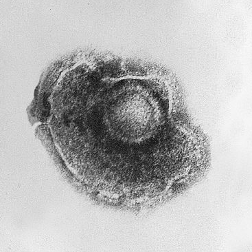 Varicella (Chickenpox) Virus