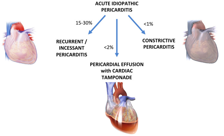 Complications of acute pericarditis