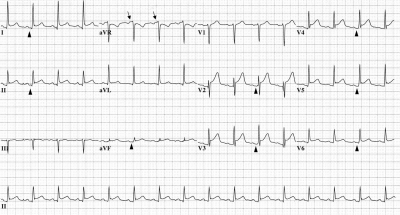Electrocardiographic abnormalities in acute pericarditis