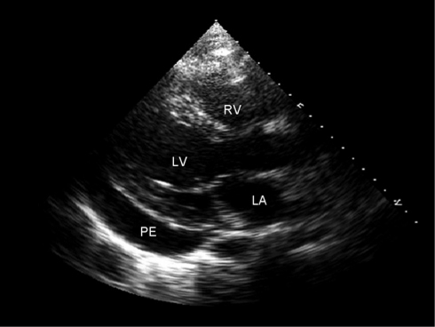 Two-dimensional transthoracic echocardiogram showing the parasternal long-axis view in a patient diagnosed as having acute pericarditis