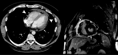 Cardiac computed tomography (CT) and cardiac magnetic resonance imaging in chronic relapsing pericarditis