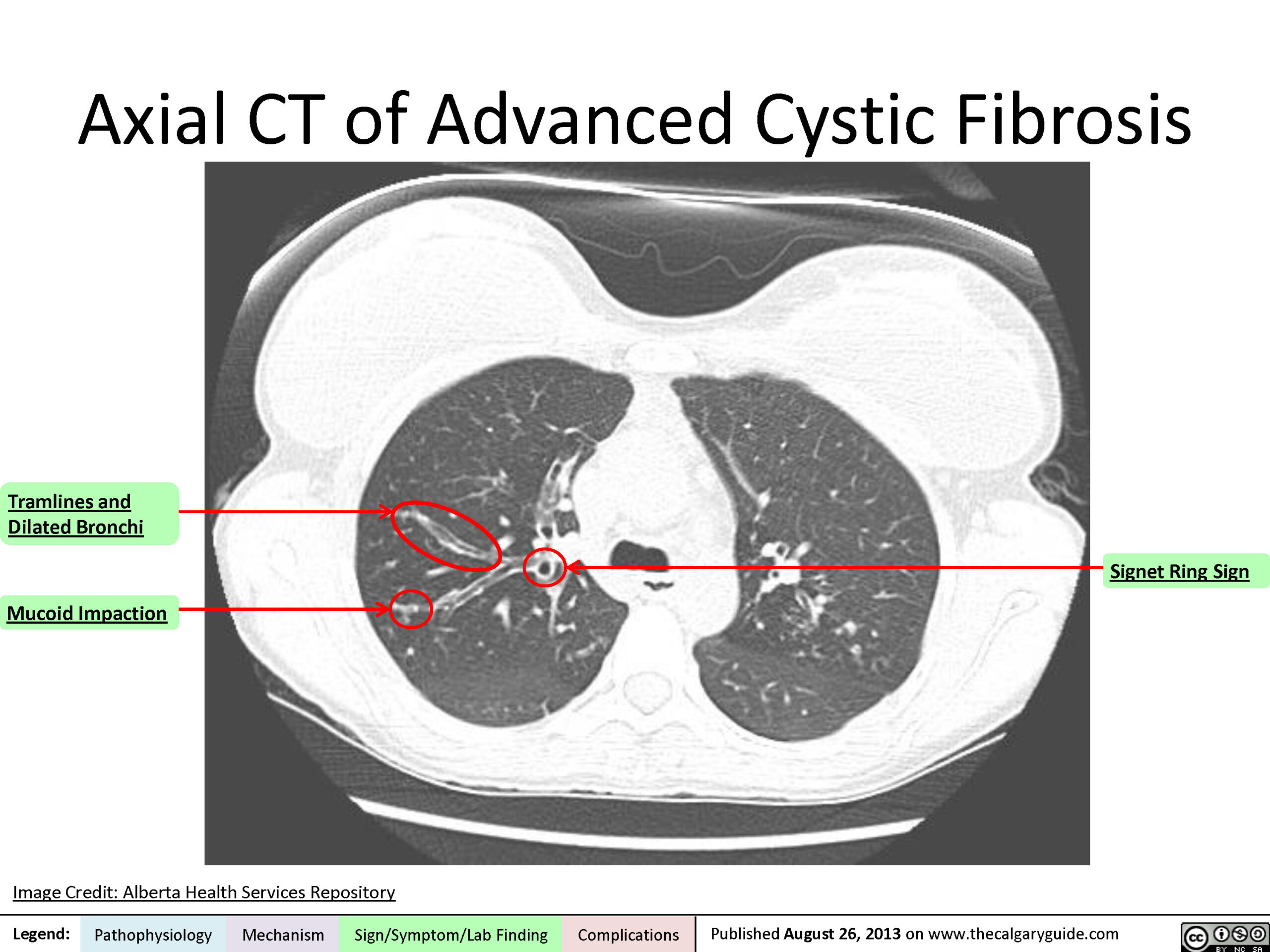 Cystic fibrosis: Axial CT