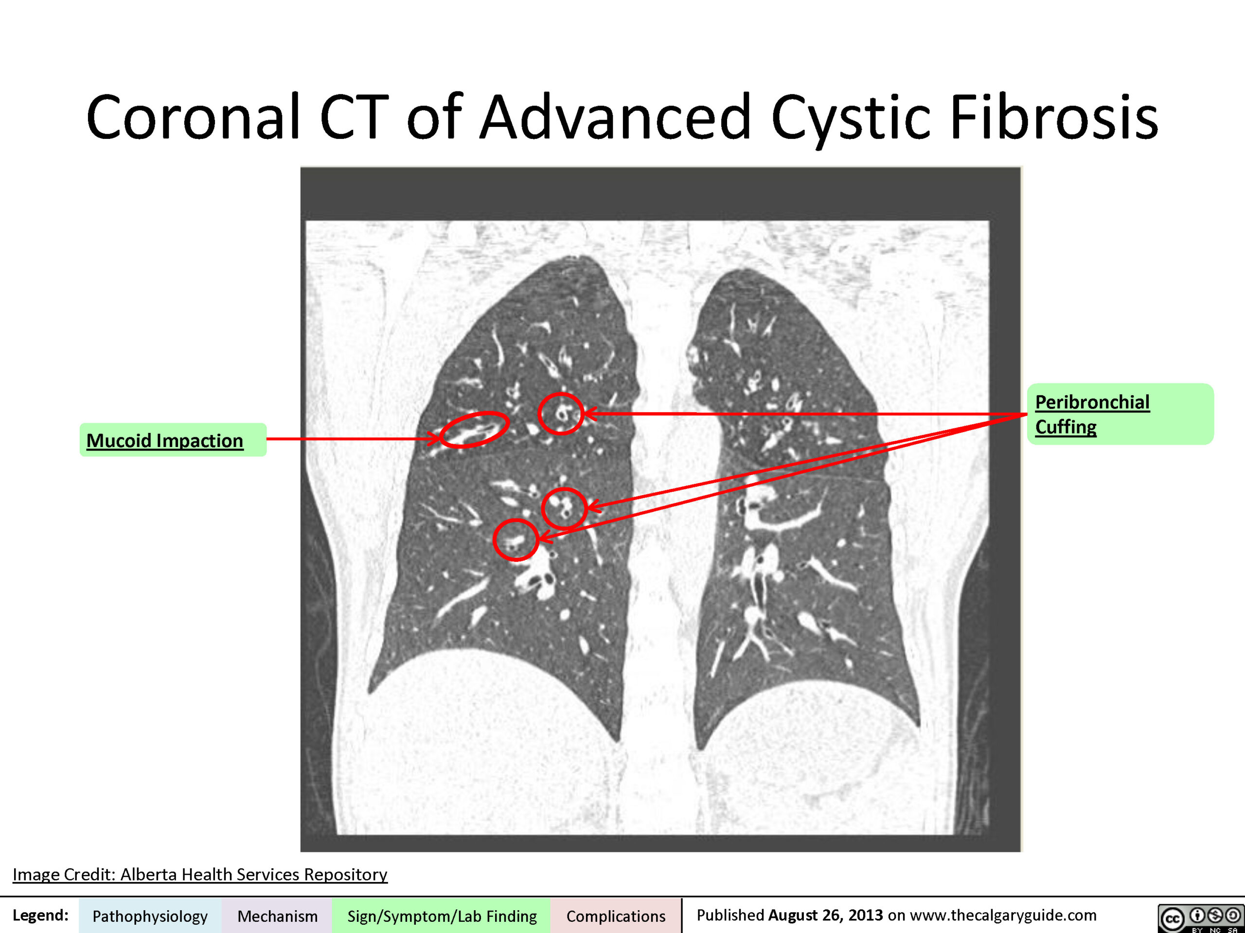 Cystic fibrosis: Coronal CT