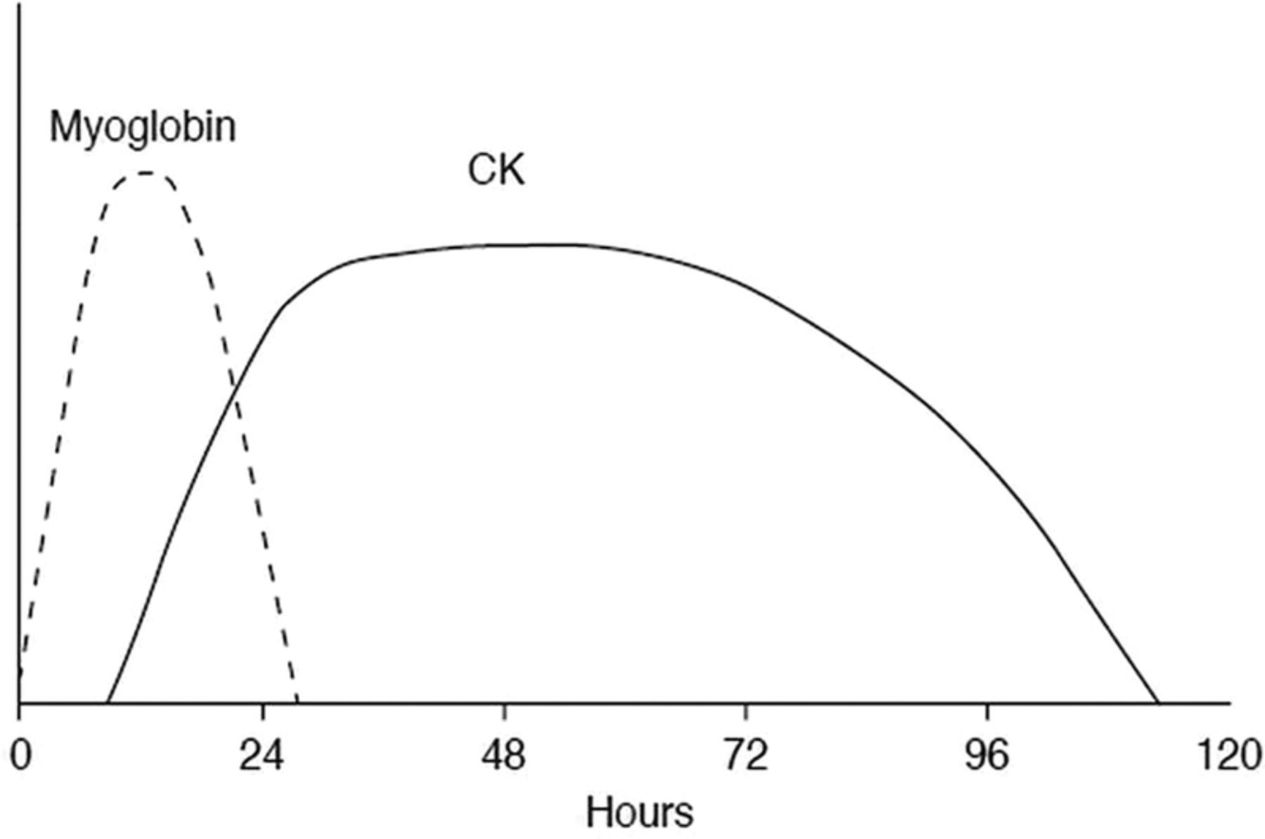 Rise and fall of myoglobin and creatine kinase (CK) during the course of rhabdomyolysis