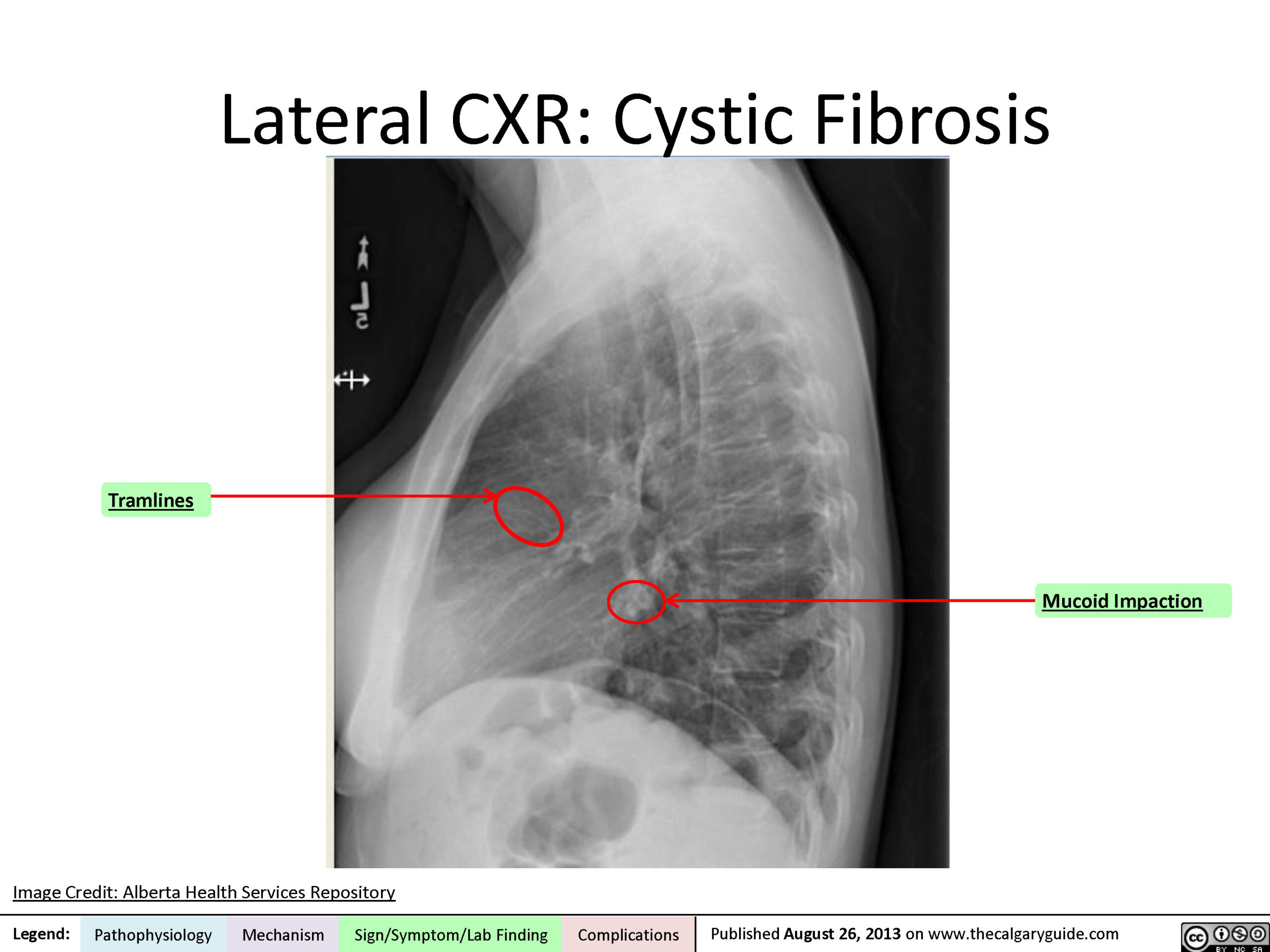 Cystic fibrosis: Lateral CXR