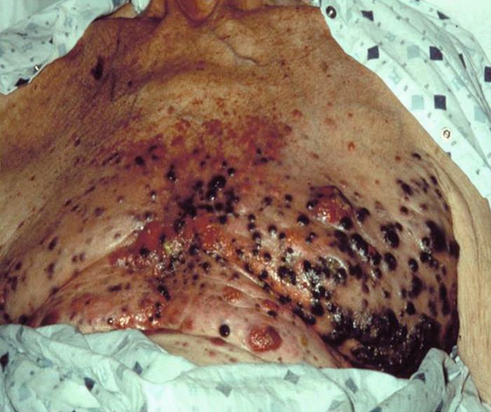 his image depicts a patient’s chest, which displays numerous darkly-pigmented cutaneous lesions, which had been diagnosed as malignant melanoma (MM)