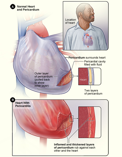 Enlarged cross-section that shows the inflamed and thickened layers of the pericardium
