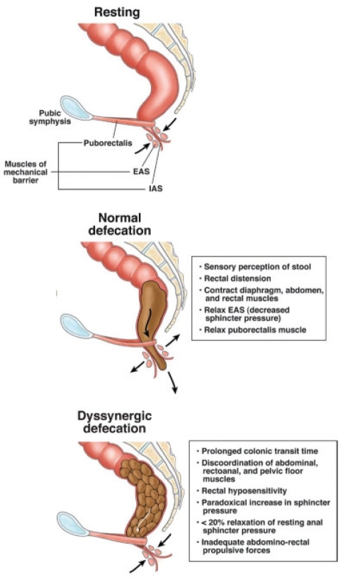 Normal anatomy and physiology of the pelvic floor in the sagittal plane at rest, during normal defecation and during dyssynergic defecation
