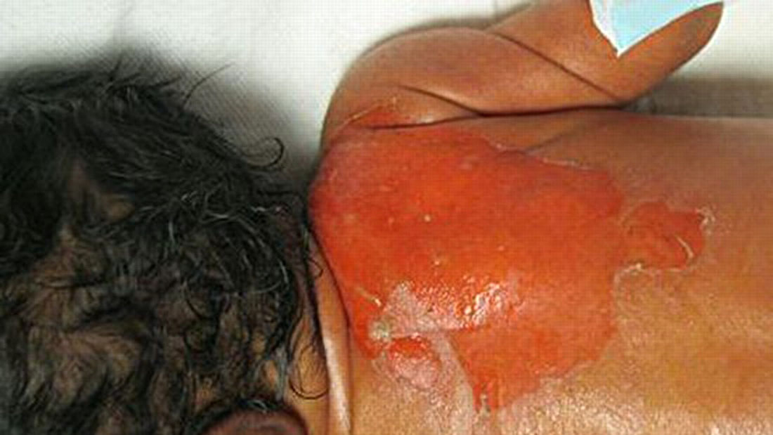 Staphylococcal scalded skin syndrome in a preterm newborn presenting within first 24 h of life
