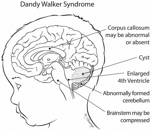 Schematic view of the brain's interior of the child with Dandy-Walker syndrome