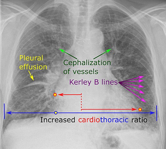 Chest radiograph of an lung with distinct Kerley B lines, as well as an enlarged heart
