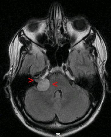 Acoustic neuroma on the right with a size of 20x22x25mm