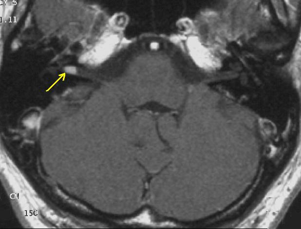 Transversal T1-weighted MRI after contrast: small acoustic neuroma