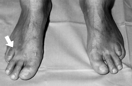 Refsum's disease in an Arabian patient. Symmetric short fourth toes (arrow).