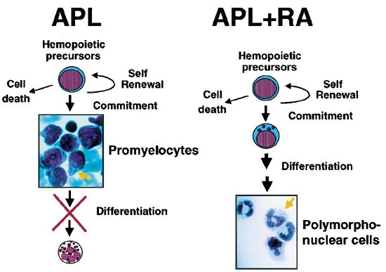 Differentiation therapy in APL