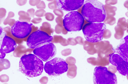 Bone marrow aspirate in aPML shows numerous abnormal promyelocytes with prominent cytoplasmic granules, characteristic of hypergranular acute promyelocytic leukemia
