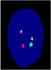 POSITIVE PML/RARA FISH with a translocation between PML (15q24) and RARA (17q21.1) in 84% of cells