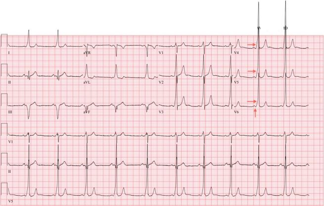 ECG at initial preparticipation physical evaluation (preablation) demonstrates a WPW pattern.