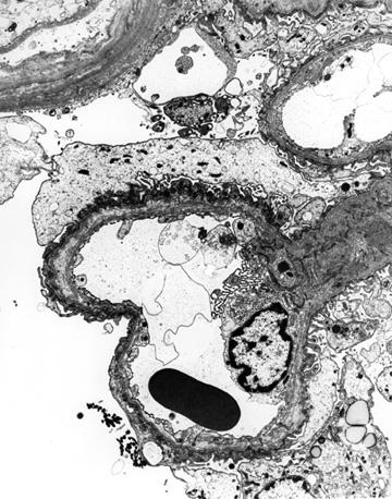 Electron micrograph from a patient with Alport syndrome