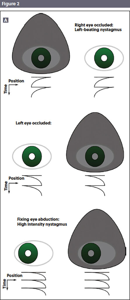 Occlusion test for nystagmus