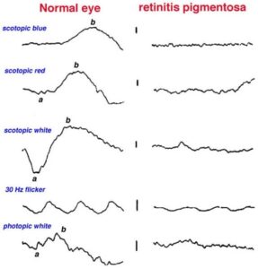 ERG recordings in a normal patient and one with retinitis pigmentosa